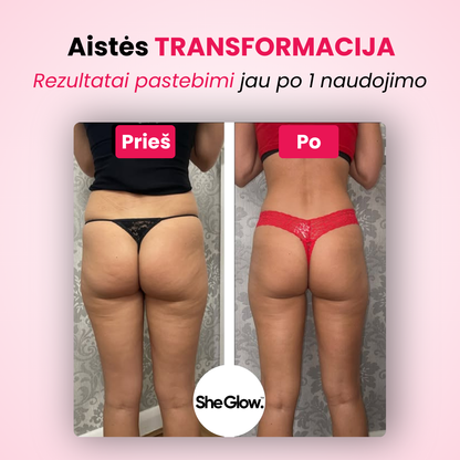 Prieš ir po nuotrauka naudojant SheGlow celiulito masažuoklį – matomi rezultatai jau po pirmo naudojimo
